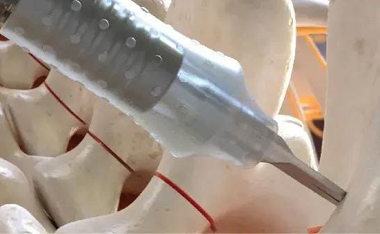 Ультразвуковой костный скальпель BoneScalpel Misonix для быстрой, точной и безопасной остеотомии